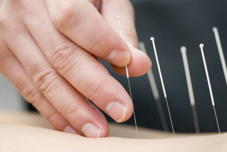 acupuncture-treatment-IMS-physiotherapists-south-city-physiotherapy